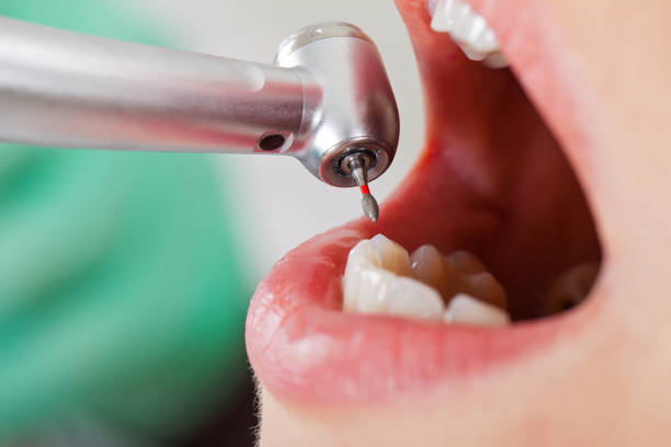 Best Emergency Wisdom Tooth Extraction in Pato, WA